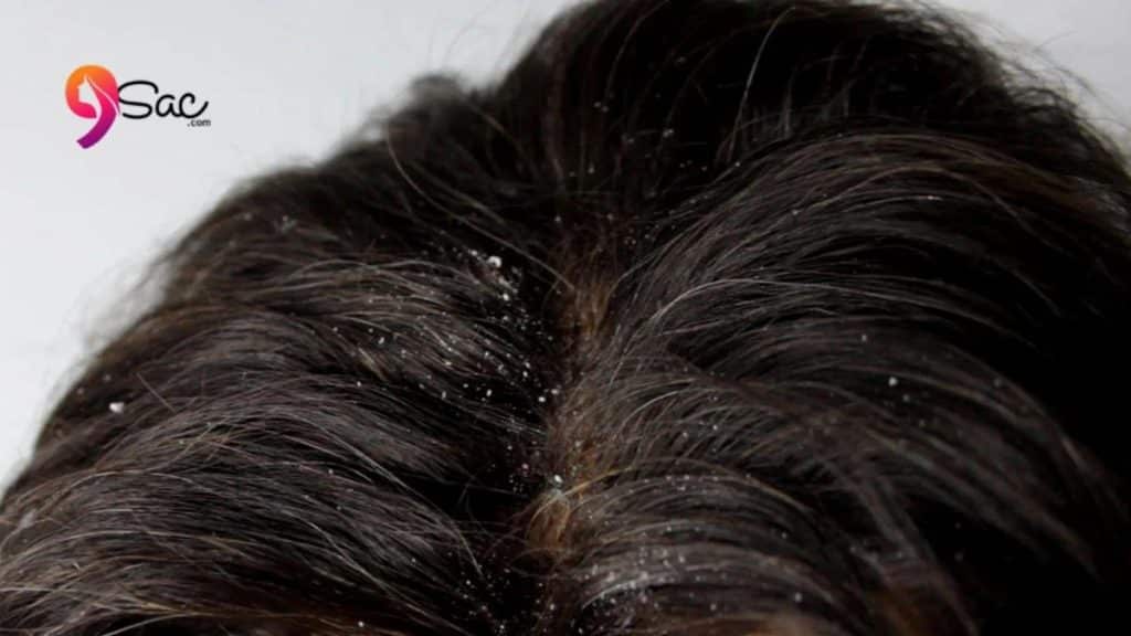 dandruff problem